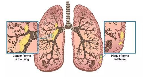 Asbestosis And Lung Disease